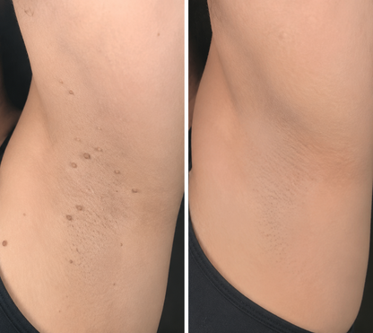 🎖️𝐎𝐟𝐟𝐢𝐜𝐢𝐚𝐥 𝐁𝐫𝐚𝐧𝐝 𝐒𝐭𝐨𝐫𝐞 |2-in-1 Microneedle & Hydrocolloid Patch🍀