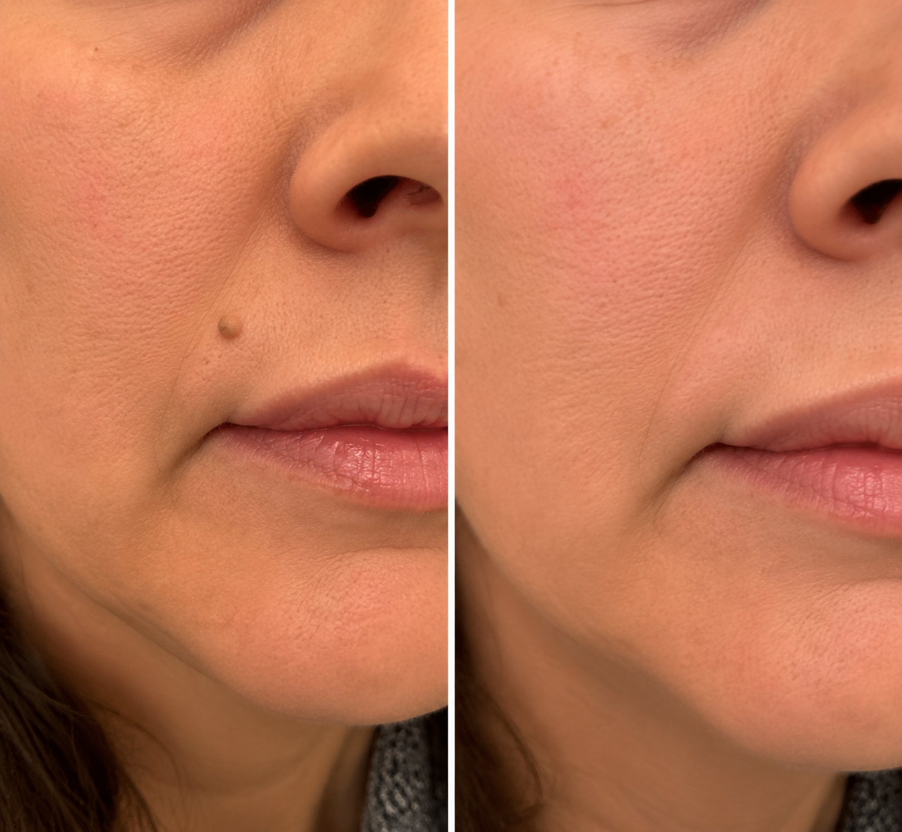 🎖️𝐎𝐟𝐟𝐢𝐜𝐢𝐚𝐥 𝐁𝐫𝐚𝐧𝐝 𝐒𝐭𝐨𝐫𝐞 |2-in-1 Microneedle & Hydrocolloid Patch🍀